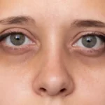 Amazing Difference Between Eyebags and Dark Circles (2026) difference between eyebags and dark circles (2)