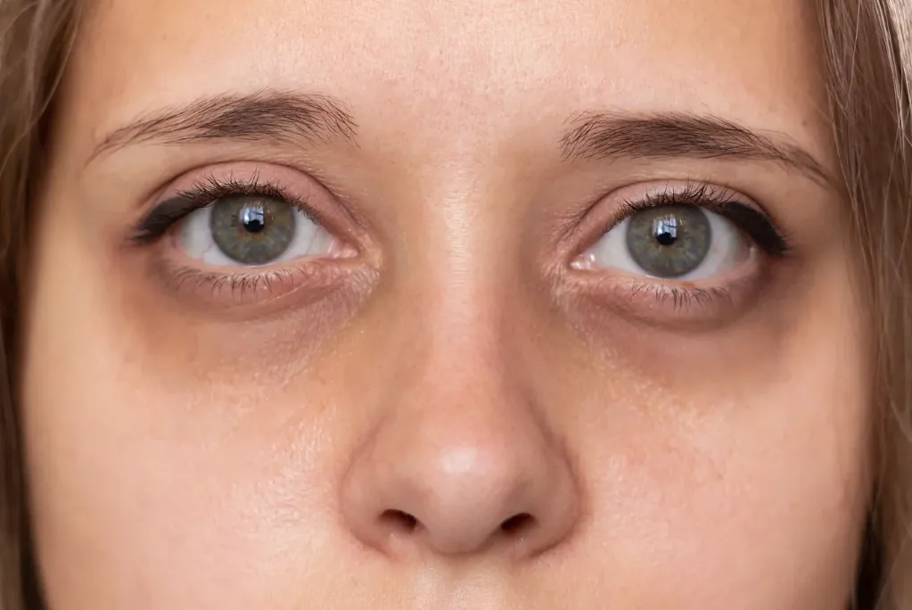 Amazing Difference Between Eyebags and Dark Circles (2026) difference between eyebags and dark circles (2)