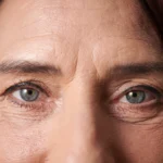 eye bags vs dark circles