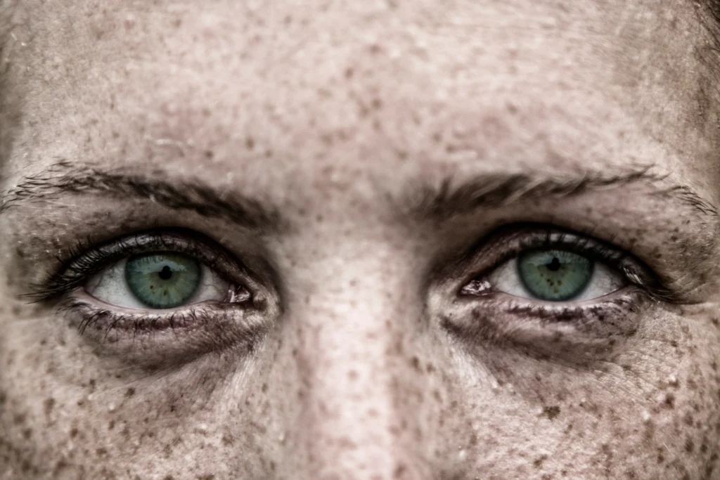 under eye circles causes