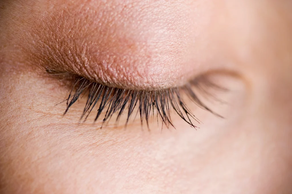 Can Dark Circles Be Genetic? What Science Says and How to Treat Them can dark circles be genetic