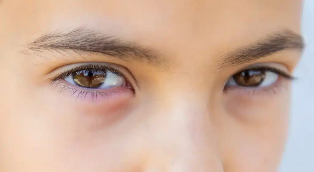 cream for sunken eyes